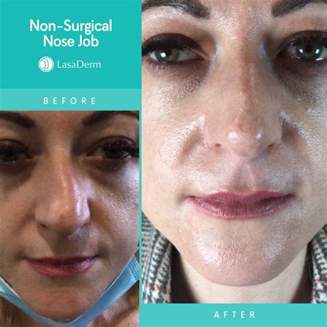 Kayleigh S Non Surgical Rhinoplasty Lasaderm