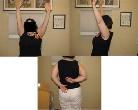 Boston Shoulder Institute – Good ROM after surgery