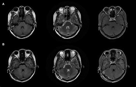 Frontiers Trigeminal Neuralgia Caused By Cavernoma A Case Report With Literature Review