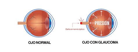 Diagrama De Ojo De Glaucoma