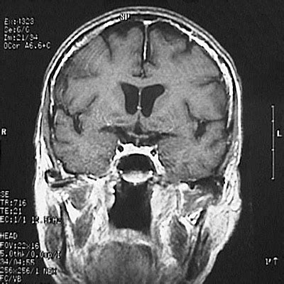 Normal Brain Mri Coronal