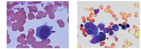 Cytology Of The Bone Marrow A Normal Plasma Cell Arrow B