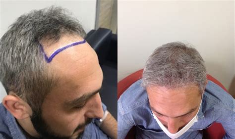 Hair Transplant In Istanbul Costs And Procedure In Turkey 2022