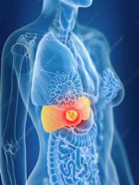 Illustration Of Female Liver Cancer Stock Image F0233951 Science Photo Library