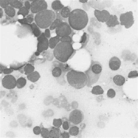 Peripheral blood smear shows pancytopenia at day 4 (×400, Wright stain). | Download Scientific ...