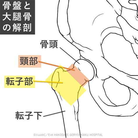 【診療紹介】大腿骨近位部骨折について【整形外科】 函館五稜郭病院