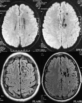 Unilateral Bubbly Cystic Brain Lesions On Mri Journal Of Clinical