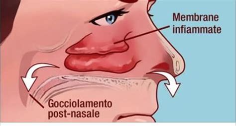 La congestione nasale è una condizione che si sviluppa quando le mucose