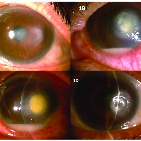 The Second Patient Also Affected By Contact Lens Related Infectious Download Scientific