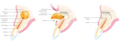 Endodontic Microsurgery