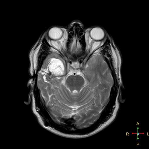 Ruptured Intracranial Dermoid Cyst Image