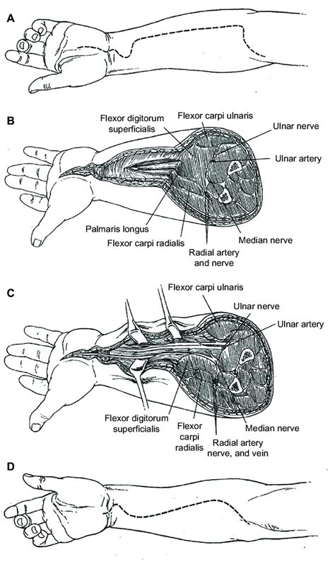 Surgical Approaches To The Volar Compartment Of The Forearm Notes A