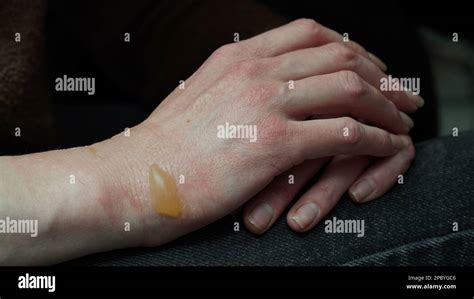 Close-up of a woman's hand with a blister from a boiled water burn, damaged skin, 1st or second ...