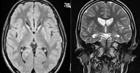 Huntington Disease