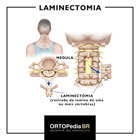 Bico de Papagaio Entenda o que são os osteófitos e como eles podem