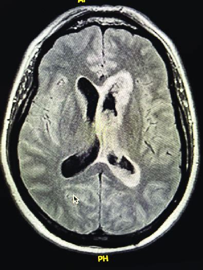 Mri Showing Diffuse Ependymal Enhancement Not Throughout The