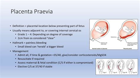 Posterior Placenta