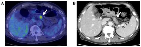 Pancreatic Fdg Uptake On Follow‑up Petct In Patients With Cancer