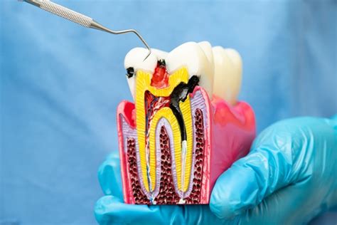 Signs You May Need A Root Canal When To See A Dentist Delaware