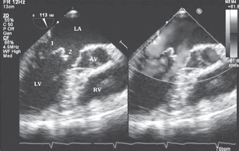 Transesophageal 2D Echocardiography Midesophageal Long Axis View Of The