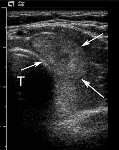 Thyroid nodules: When to biopsy | Applied Radiology