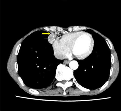 Contrast-enhanced computed tomography imaging of pulmonary ...