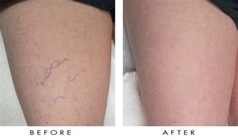 Spider Veins On Legs Before After Keller Med Spa And Laser