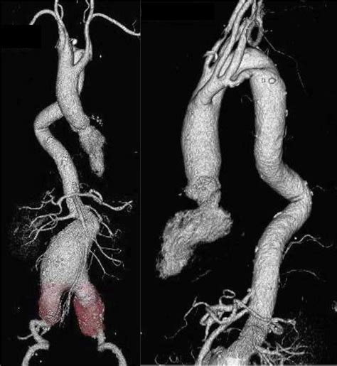 The 3d Ct Revealed Double Aortic Arch Separated At The Distal Portion