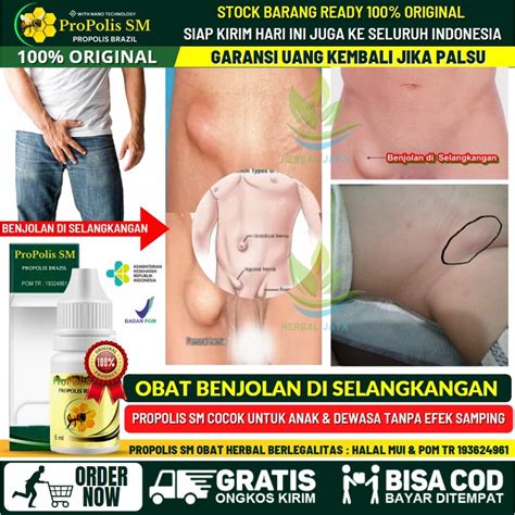 Jual OBAT BENJOLAN DI SELANGKANGAN 100 HERBAL Penghilang Benjolan