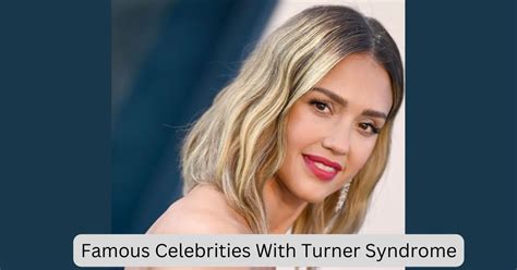 Celebrities With Turner Syndrome Top 20