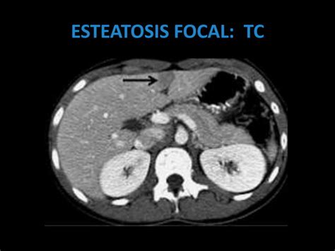 LESIONES FOCALES HEPATICAS EN ULTRASONIDO PPT