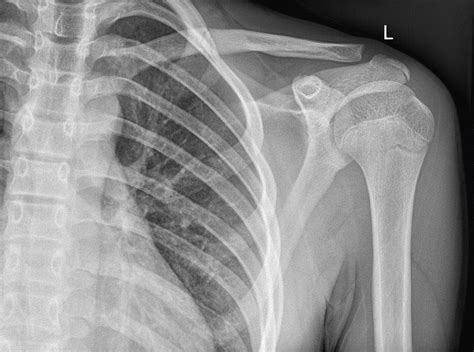 NORMAL SHOULDER 5 | Buyxraysonline