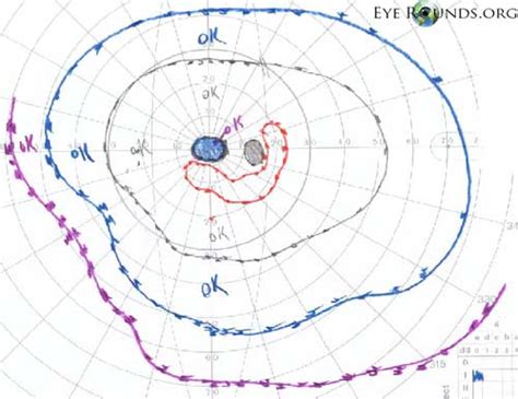 Cone-rod dystrophy: The University of Iowa, Ophthalmology