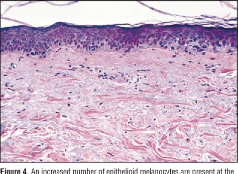 Amelanotic Melanoma Histology