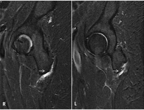 Typical Mri Findings Of Bilateral Ischial Bursitis Bilateral Weavers