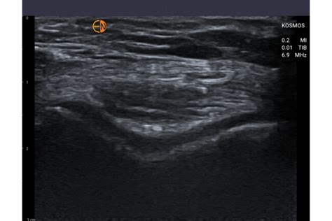 Musculoskeletal Ultrasound MSK Echonous