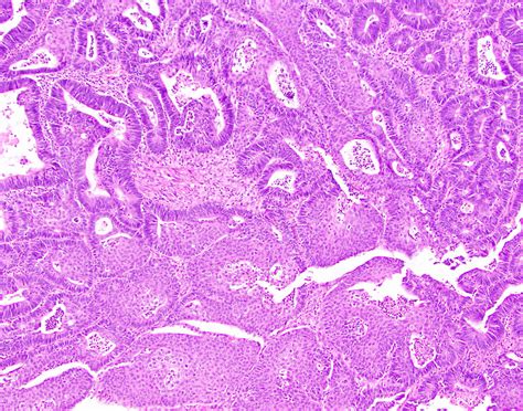 Adenosquamous Cell Carcinoma