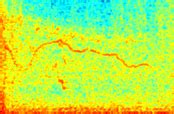 COPD Lung Sounds: Understanding Wheezes, Crackles, and More