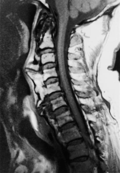 Dysphagia Due To Cervical Osteophytes Clinical Imaging