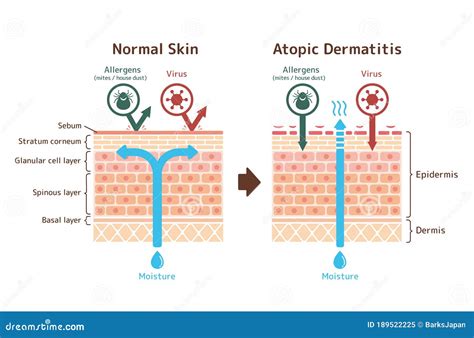 Visão Seccional Da Dermatite Atópica E Ilustração Comparativa Do Vetor