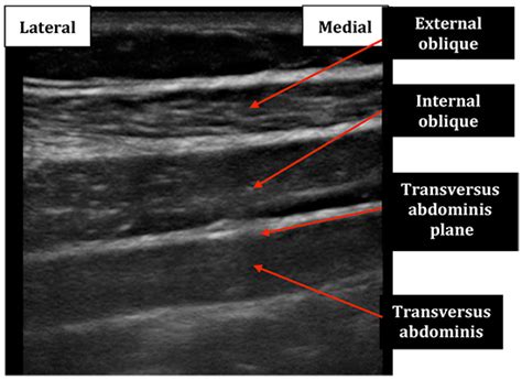 Transversus Abdominis Plane Block Virtual Library