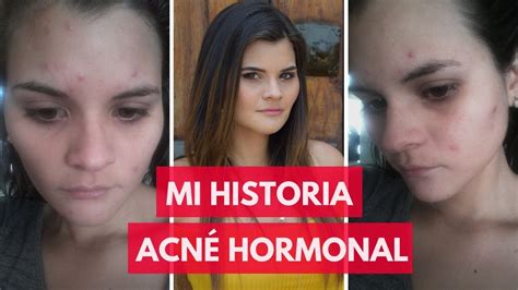 ¿cÓmo Eliminar El AcnÉ Hormonal Youtube