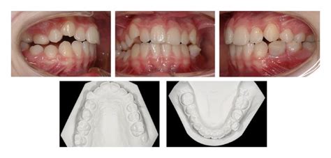 Pretreatment Intraoral Photographs And Study Casts Occlusal View