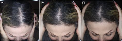 The Efficacy Of The Combination Of Topical Minoxidil And Oral