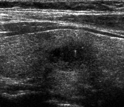 Implementation Of Evidence Based Guidelines For Thyroid Nodule Biopsy