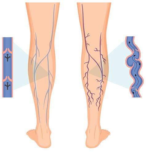 Do Dilated Leg Veins Have Any Adverse Effects On The Body