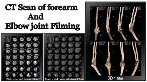 Ct Elbow Positioning Bazaarstory
