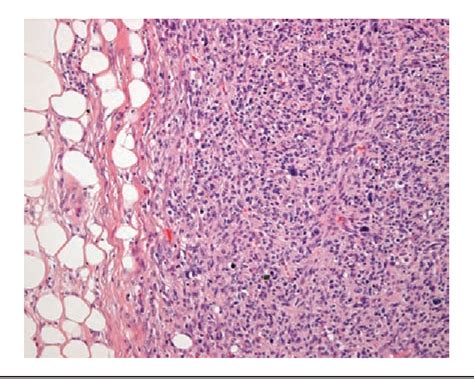 Figure 2 From Dedifferentiated Liposarcoma With Lipoma Like Well