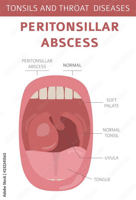 Tonsils and throat diseases. Peritonsillar abscess symptoms, treatment ...