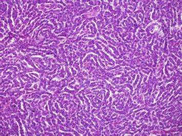 Ovarian Sex Cord Stromal Tumours And Their Mimics Pathology